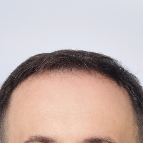 miszczyk-wlosy-27a-aspect-ratio-500-500