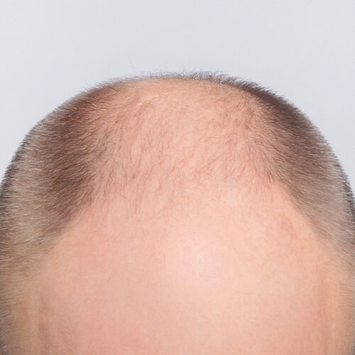 miszczyk-wlosy-31c-aspect-ratio-500-500