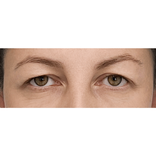 miszczyki-powieki-6a-img-8812-aspect-ratio-500-500