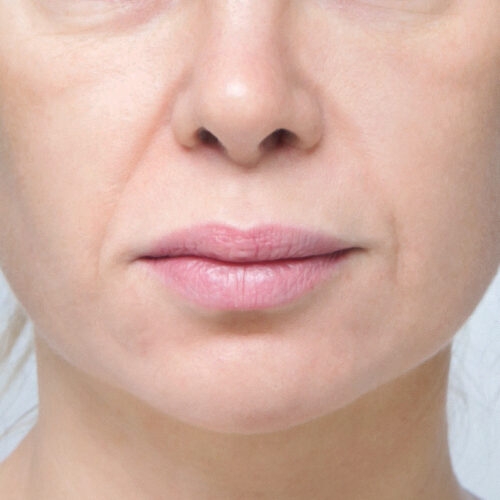 noname-endo-midface-id70513-5a-aspect-ratio-500-500