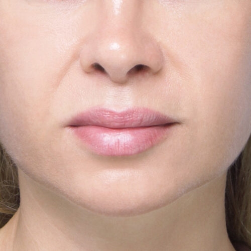 noname-endo-midface-id70513-5b-aspect-ratio-500-500